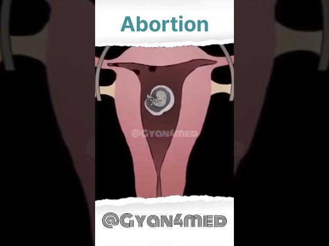 Abortion Animation