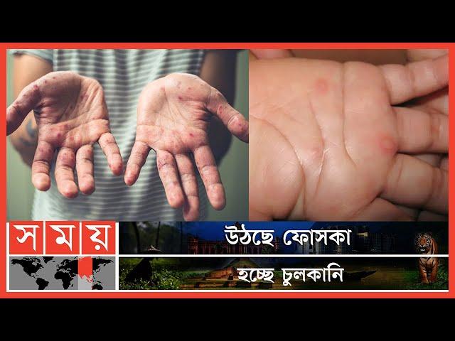 শিশুদের মধ্যে দেখা দিয়েছে হ্যান্ড-ফুট-মাউথ রোগের প্রকোপ  | Hand Foot and Mouth Disease | Somoy TV