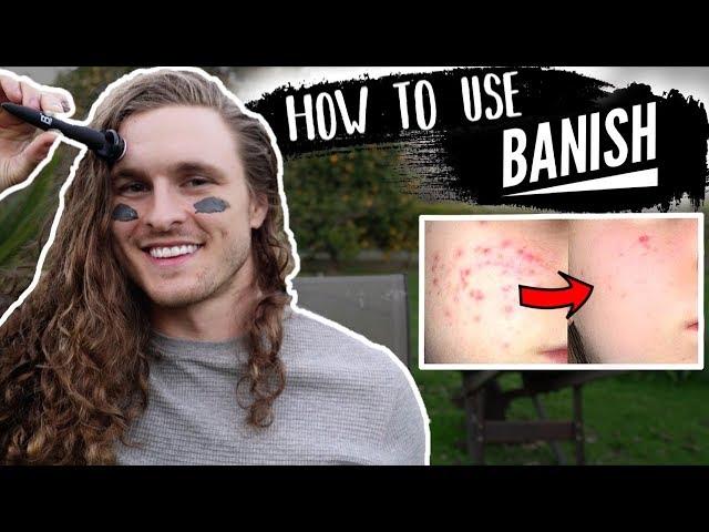 HOW TO GET RID OF ACNE SCARS AT HOME (BANISH)