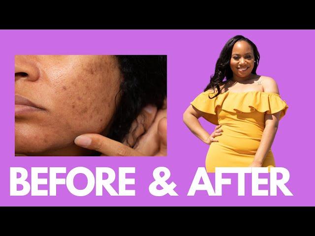 HOW I CLEARED MY ACNE & HYPERPIGMENTATION | SKIN CARE ROUTINE