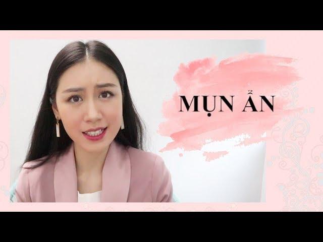 THANH LÝ MỤN ẨN!!! NGUYÊN NHÂN | GIẢI PHÁP | DÙNG SẢN PHẨM GÌ?