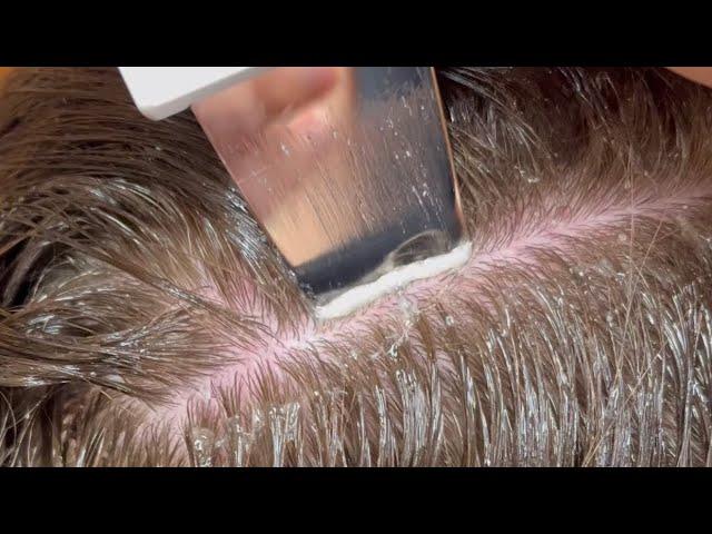 Scalp Treatment for Dandruff/Buildup