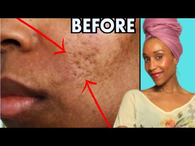 Acne BE GONE...The Supplement That OBLITERATED my Acne!