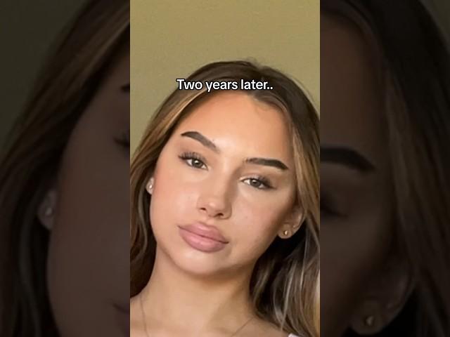 Moon face is REAL
