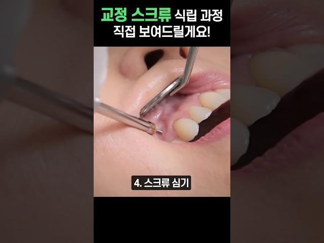 교정을 위해 잇몸에 나사를 박는다고요?!?! #shorts