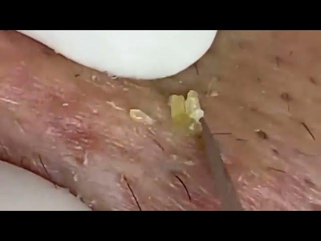 حب الشباب الرؤوس السوداء #Blackheads #acne #pimple