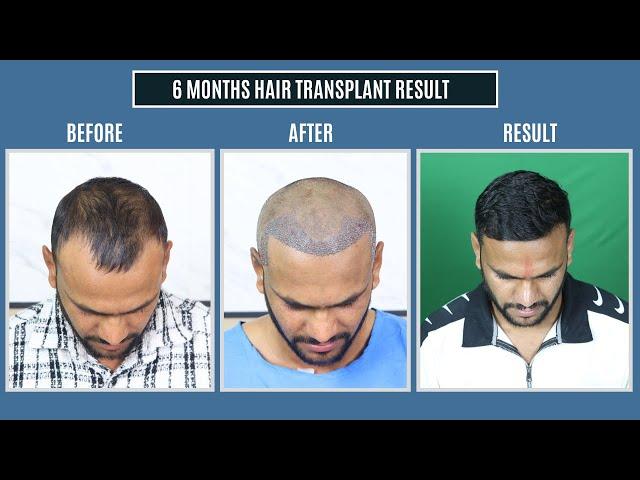 Hair Transplant in Indore | Cost of Hair Transplant in Indore | Hair Transplant Doctor in Indore