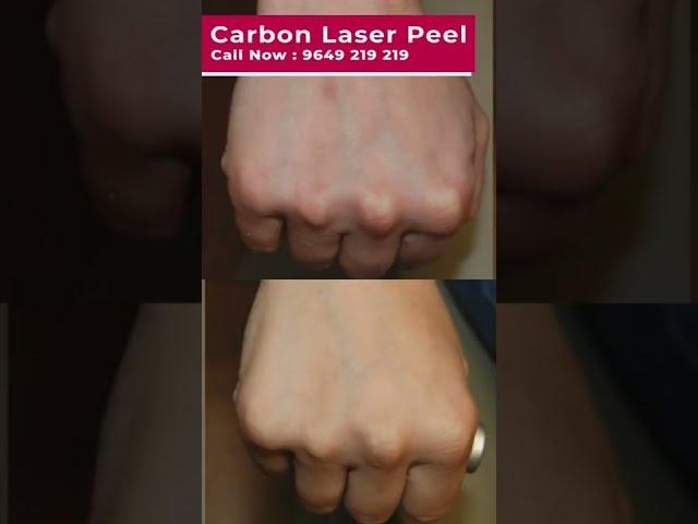 Never Underestimate The Influence Of Carbon Laser Peel For Hand. #carbonlaserforhan #skinaaclinic