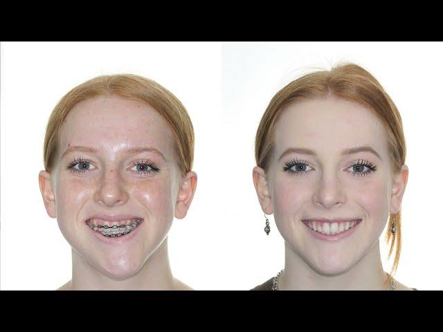 Corrective Jaw Surgery with Drs. Relle and Walline | Los Angeles