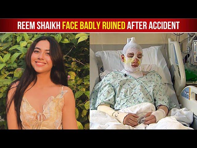 Reem Shaikh Badly Injured And Admitted To Hospital After Hot Oil Splash All Over Her Face