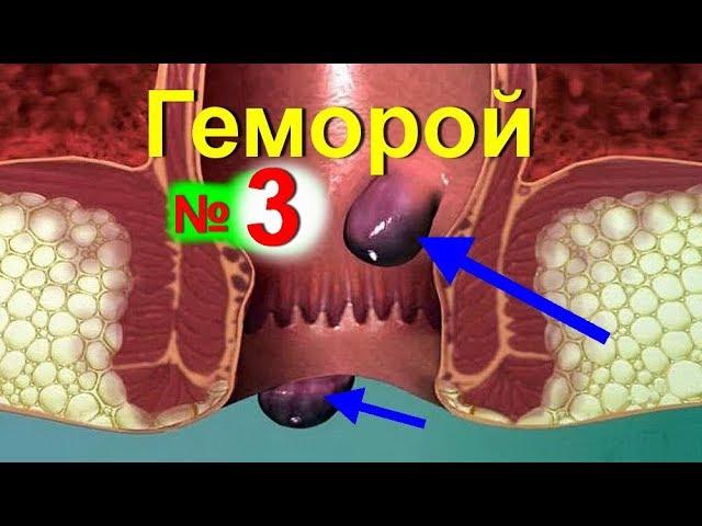 Лечение геморроя в домашних условиях. Как лечить геморрой народными средствами. Как убрать боль