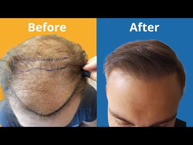 Hair Transplant Before and After - Month by Month results Elithair