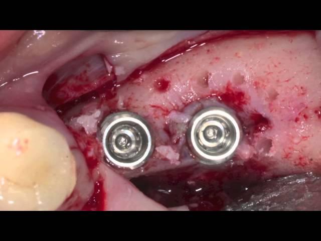 i Gen membrane with AnyRidge implant2