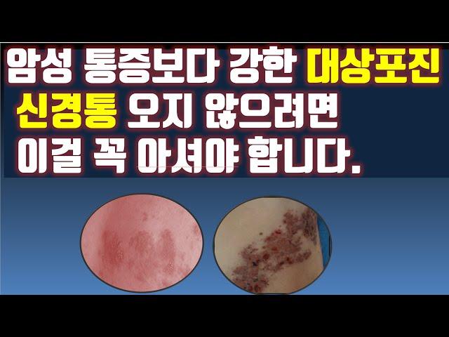 암성 통증보다 강한 대상포진 신경통 오지 않으려면 이걸 꼭 아셔야 합니다.