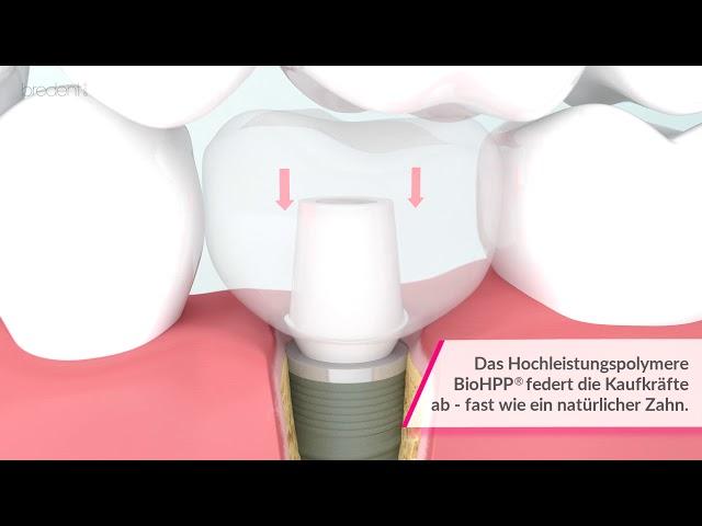 BioHPP: neue Dimension in der prothetischen Versorgung von Implantaten