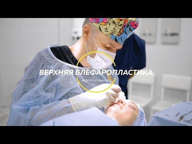 Верхняя блефаропластика, этапы операции, результат через 3 месяца | Андрей Ковынцев