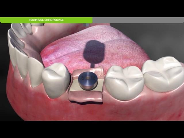 Biotech Dental :Protocole chirurgical de pose d'un implant dentaire KONTACT sous-crestal