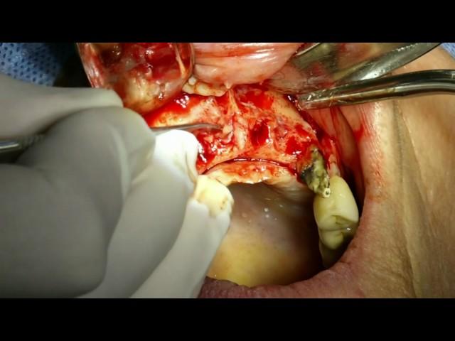 MARCHA BLANCA  2 TRIAL PERIOD