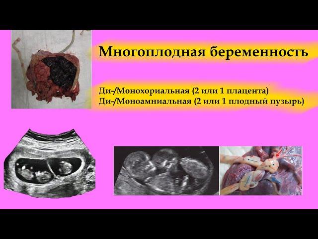 Многоплодная беременность. Ведение: рекомендации, протоколы, УЗИ, роды. Двойняшки. Близнецы.