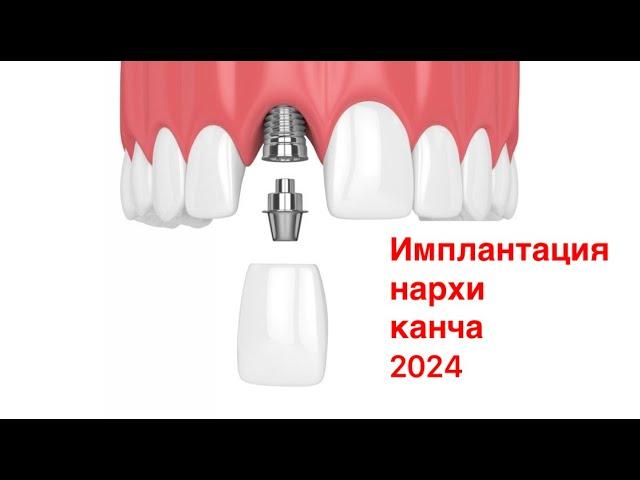 Имплантация нархи канча 2024. Тел +998911777720