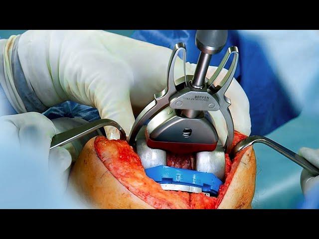 Surgical Technique Manual Procedure AESCULAP® IQ Columbus® - Instruments Video