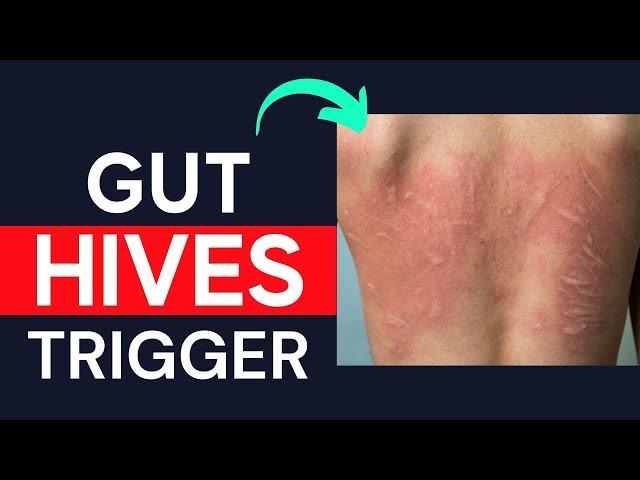 Gut Trigger For Chronic Hives On Skin (Including Chronic Urticaria, Dermatographia, Angioedema)