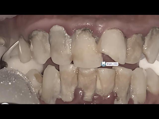 Can You Watch Till the End? Top 3 Most Shocking Tartar Removals!#139