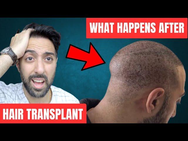 6 Struggles after a Hair Transplant (what to expect)