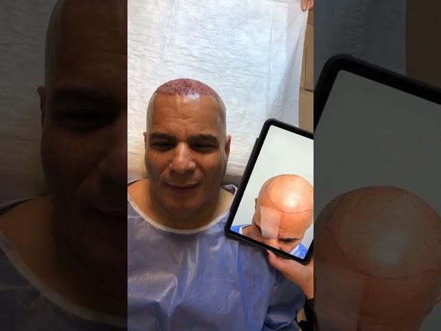 Sapphire FUE hair Transplant by TAS TEAM at Tas Hair Clinic Istanbul, Turkey