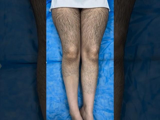 Waxing Hairy Legs #health #shortvideo #youtibeshorts #waxing #shorts #hair