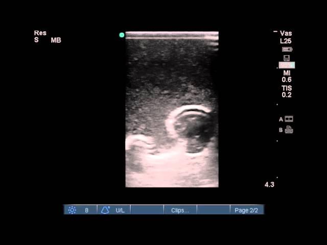 CVC Procedure Phantom Fistula