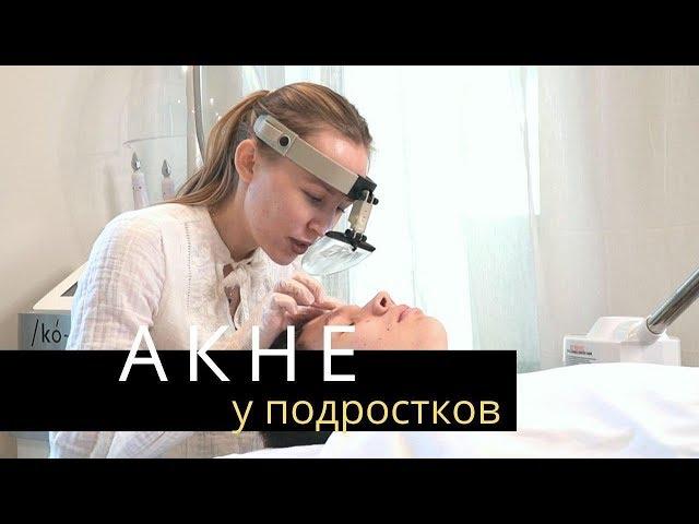 АКНЕ. Прыщи у подростков | Лечение Акне у косметолога | Anastasia Talan