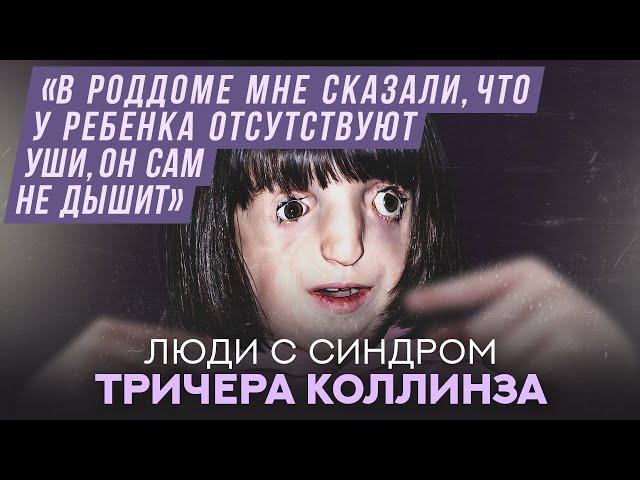 Люди с синдромом Тричера Коллинза | Хочу спросить