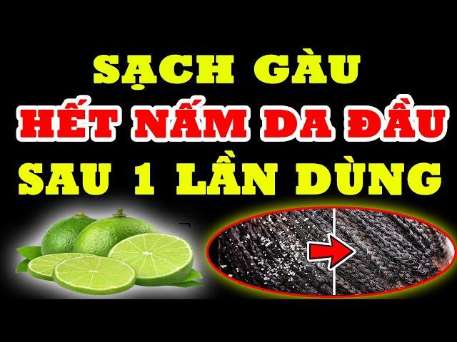 Trị Gàu Nấm Da Đầu Cỡ Mấy Cũng Hết Ngay Lập Tức, Chỉ Với Tuyệt Chiêu Đơn Giản SAU MỘT LẦN THỰC HIỆN