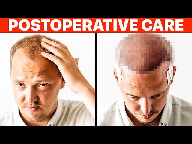 Hair Transplant: PostOp Recovery