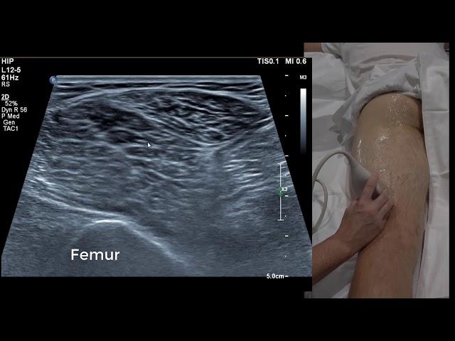 Hamstring Ultrasound 101