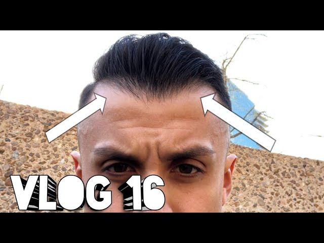 How I got my hairline back // Inspirational Vlog