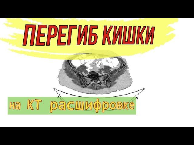 ПЕРЕГИБ КИШКИ на расшифровке КТ виртуальной колоноскопии. Болезнь Пайра синдром.