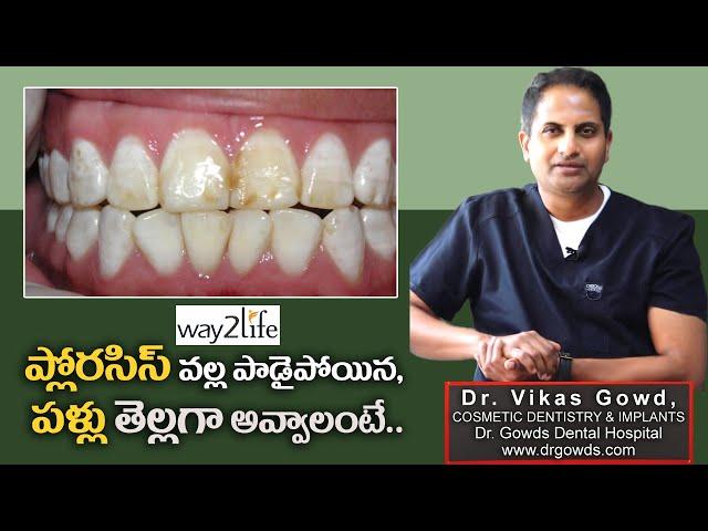 Best Dental Fluorosis Treatment | Fluorosis Causes | Fluorosis Prevention | Dr VIKAS 3 | way 2 life