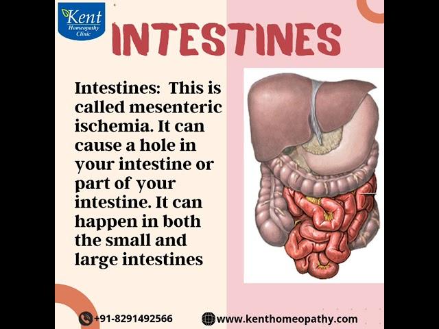 Ischemia        #kenthomeopathyclinic #drkukrejakalani #8291492566 #onlineconsultation