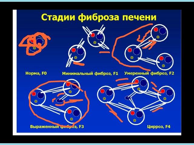 Особенности изменения печени у детей с муковисцидозом