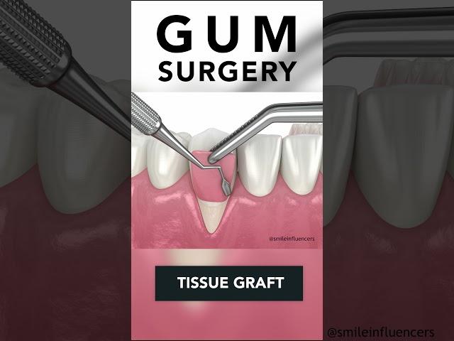 Receding Gums Surgery