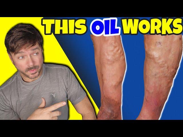 Ancient Oil Shrinks Varicose Veins Naturally! | Chris Gibson
