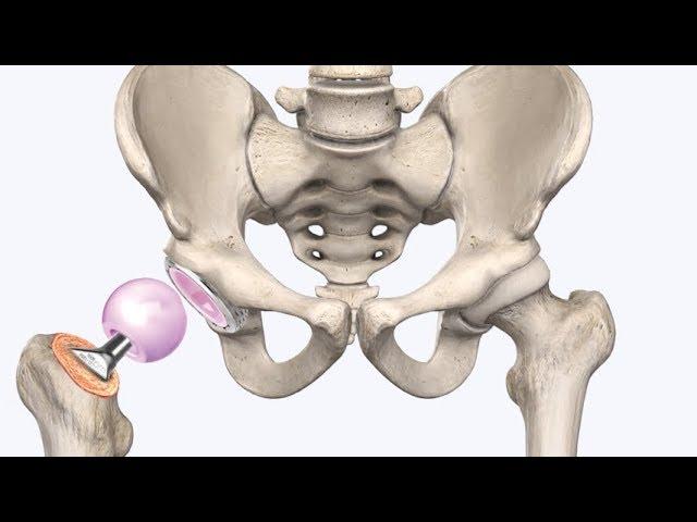 Замена тазобедренного сустава - sustavy.od.ua