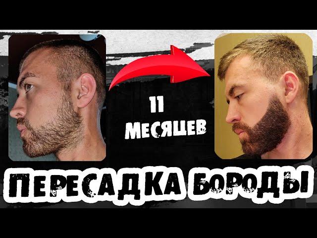 Пересадка бороды, не сделай ошибок!  Выпуск 54. Андрей Борода