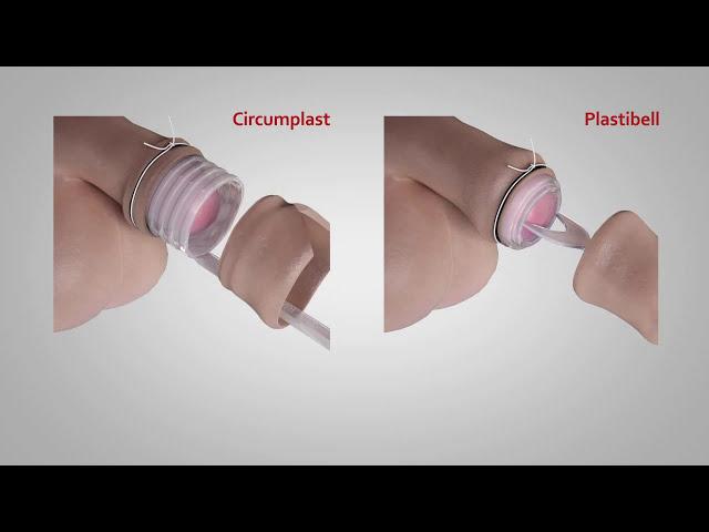 A comparison of Circumplast® and Plastibell® Circumcision Devices