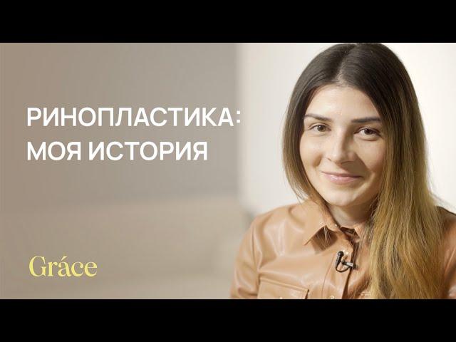 RHINOPLASTY: MY STORY | Oleg Kompaniets | Grace Clinic | reviews