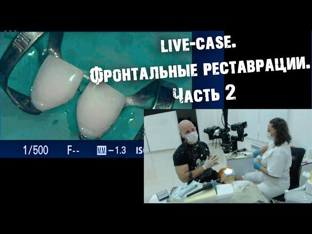 Live-Case.Фронтальные реставрации. Часть 2