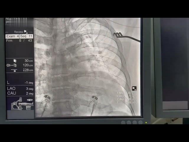 Pacemaker implantation in left superior vena cava – Video S1 [509860]