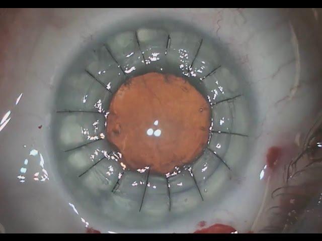 Cornea transplant on an eye with prior RK surgery in 3 minutes - Shannon Wong, MD.  6/5/16.